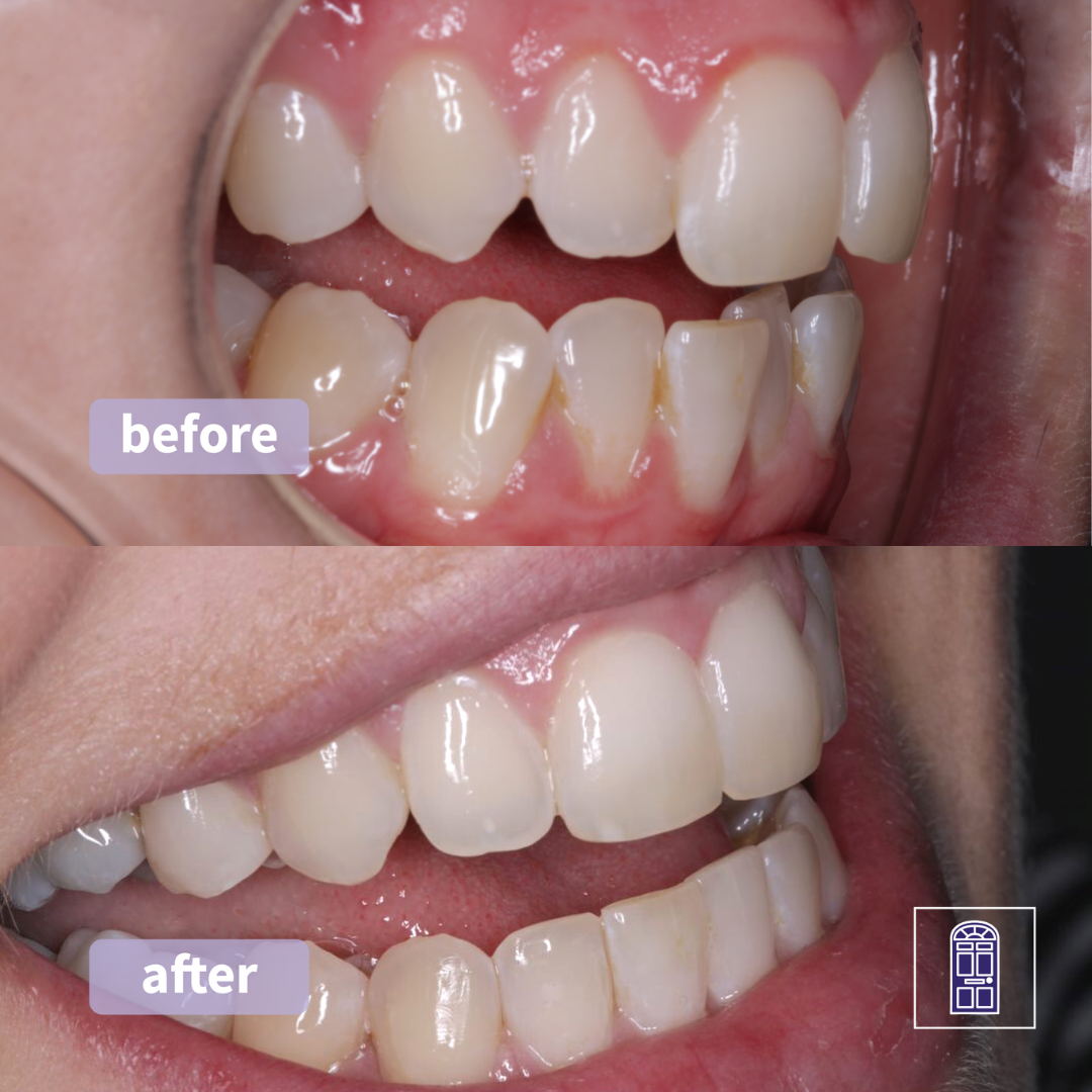 Hopkins & Poyner Dental Invisalign Invisible Brace York Harrogate