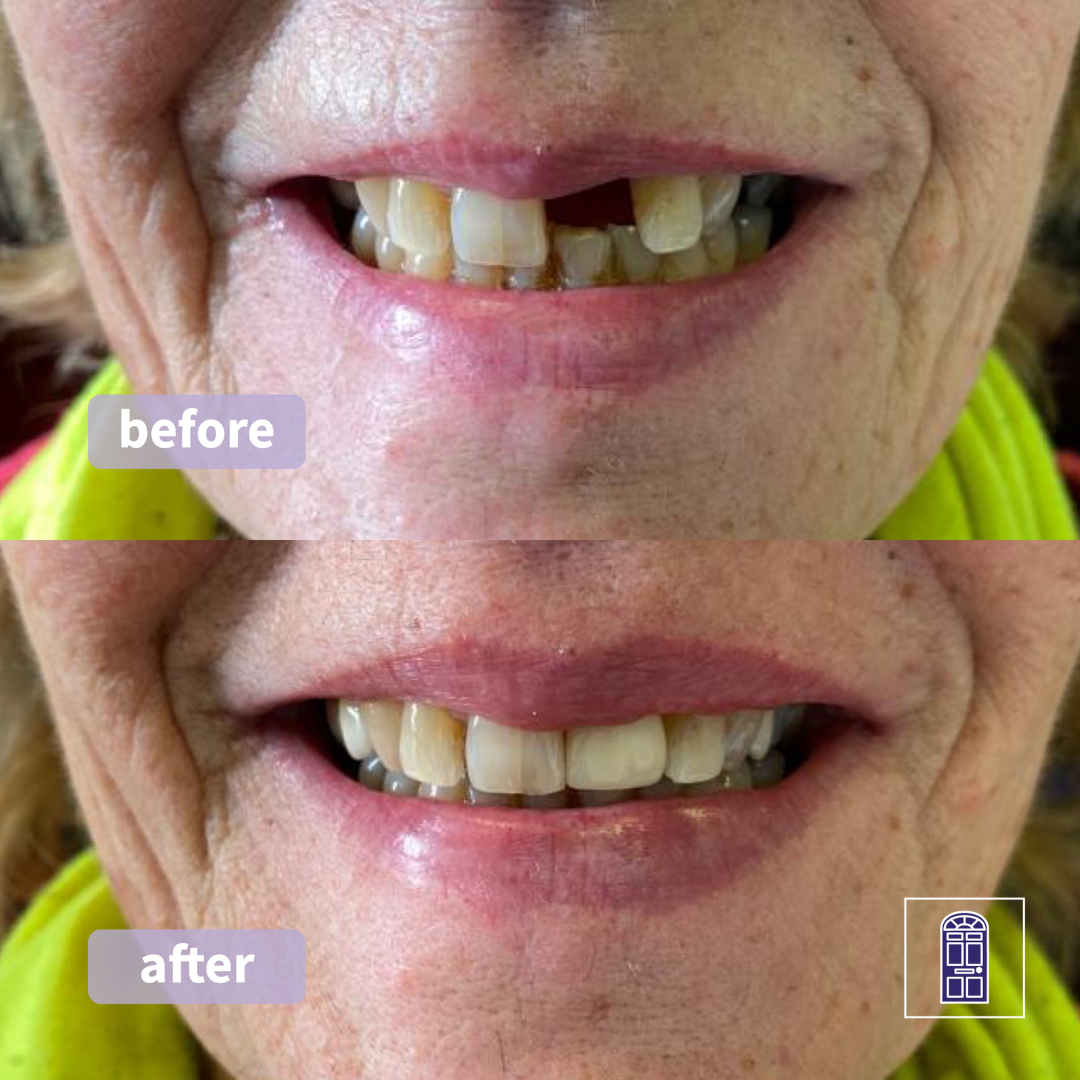 Havelock Dental Implants Clinic Smile Makeover Scarborough Whitby North Yorkshire Implant