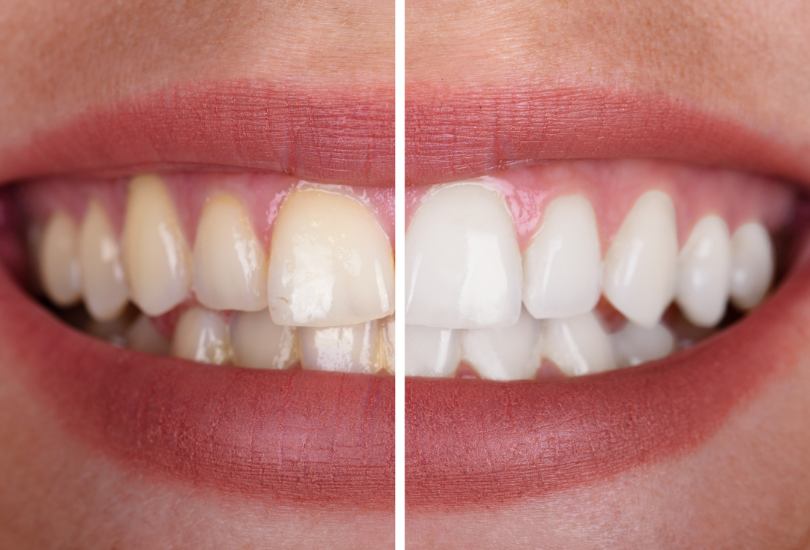 Teeth Whitening Brighter Smile Whiter Teeth York Dentist city centre