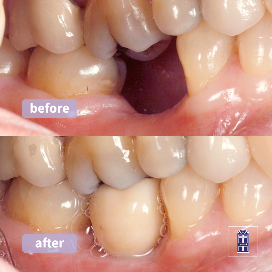 dental implant york implants missing teeth harrogate