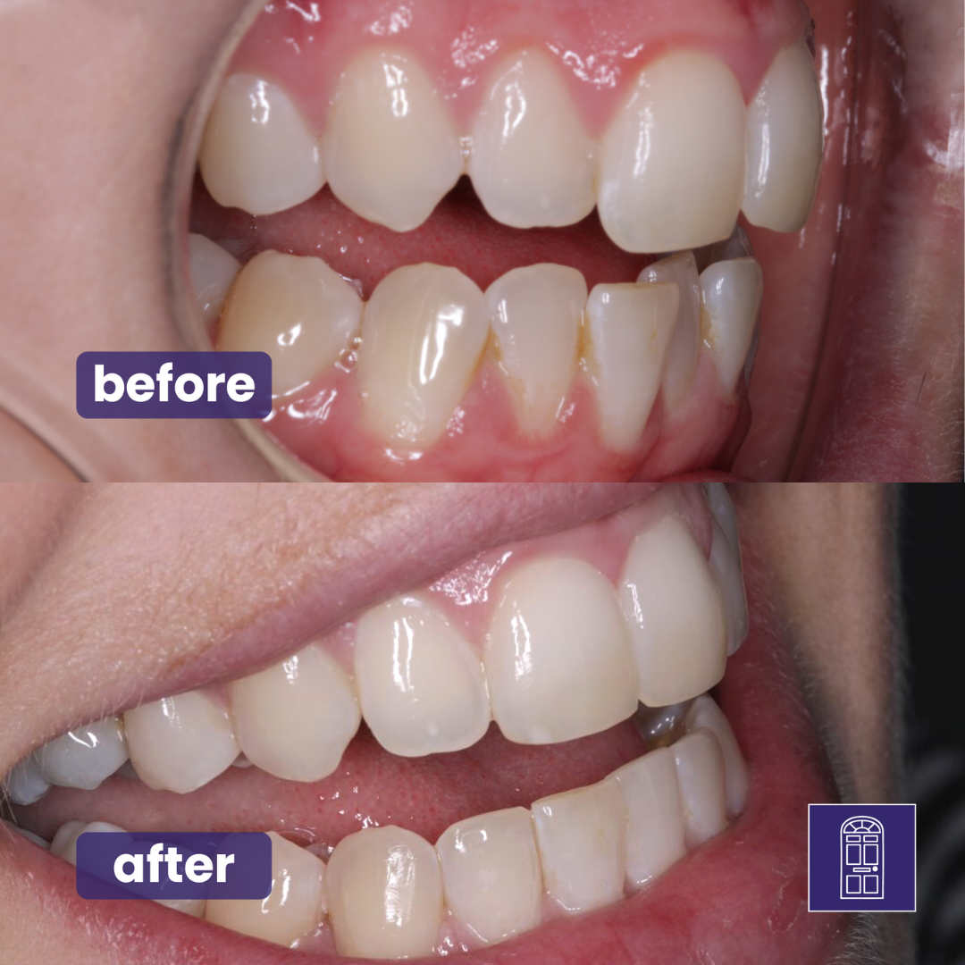 Invisalign Open Day Harrogate Straight Teeth Clear Aligners York City Centre Dental Implants