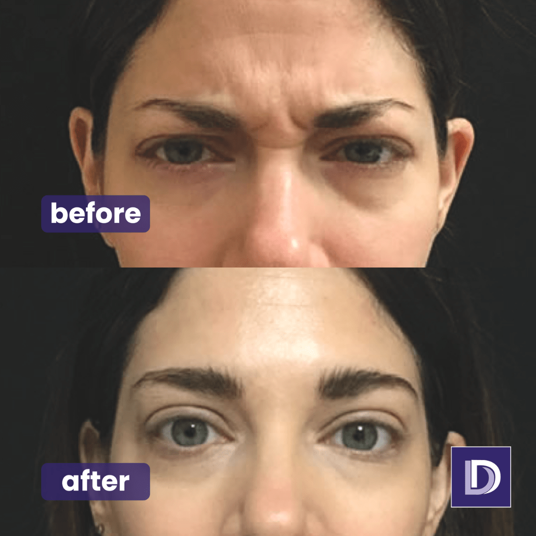 Hopkins & Poyner Dental Facial Aesthetics Lip AntiWrinkle in York