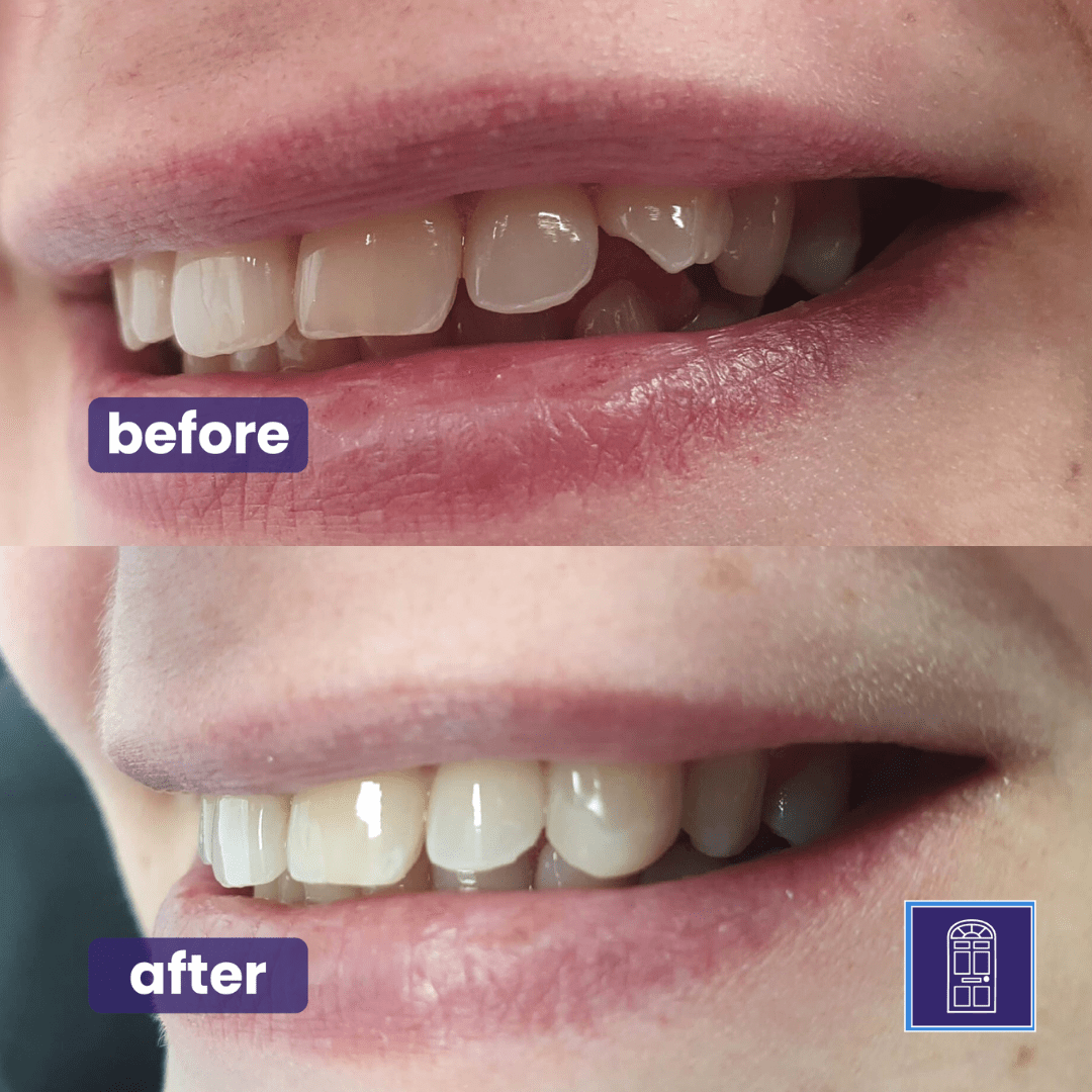 Composite Bonding York Composite Bonding York city-centre Harrogate smile makeover